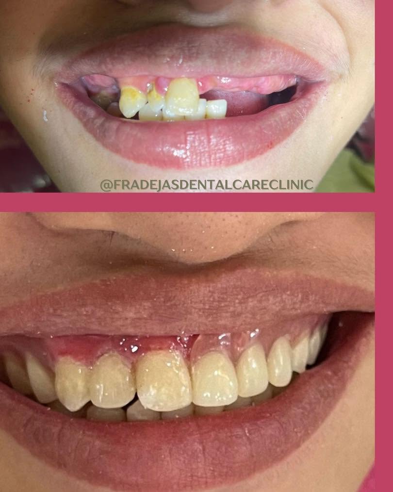 Deep Cleaning and Stain Removal at Fradejas Dental Care Clinic