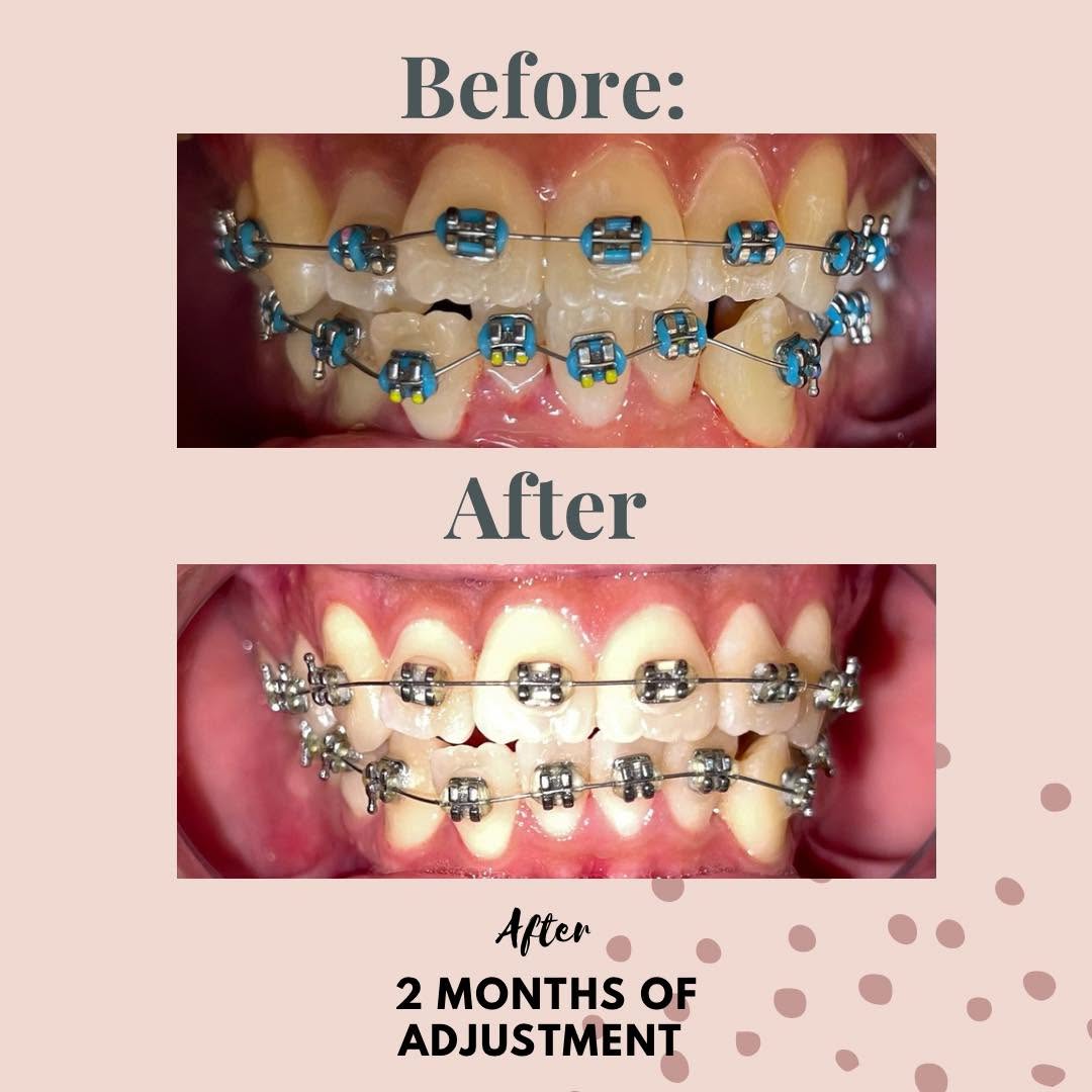 Braces Adjustment — 2 Months Progress at Fradejas Dental Care Clinic
